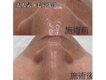美ネージュの雰囲気（【毛穴洗浄】ハイドロフェイシャルで徹底毛穴ケア。）