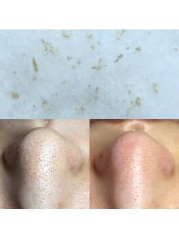 ビューティーネイル(Beauty Nail)/毛穴エクストラクション