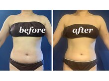 アンプリール(emplir)/冷却美容痩身　　施術前・後　