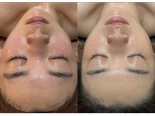 リノア(Lino'aka)/セルマン サロンケア8回目