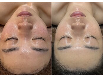 リノア(Lino'aka)/セルマン サロンケア8回目