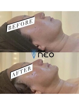 エイプリル/【蓄熱式超音波】比較写真