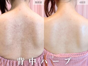 レヴェリー 心斎橋店(REVERIE)/背中ハーブピーリング4回目