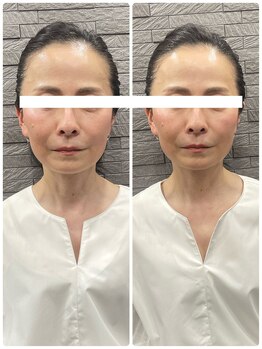 長寿鍼灸院 長寿整骨院/美容鍼50本の効果★ハリ・ツヤ