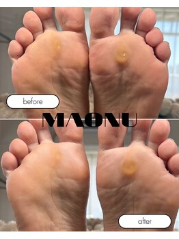 マオヌー(MAONU)/韓国式足裏角質ケア　症例写真