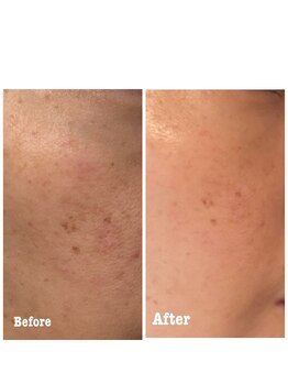 エヌプラスビューティー(N+beauty)/光フォト１回施術後