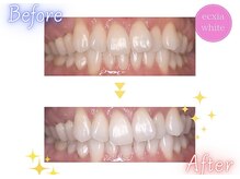 エクシアホワイトニング 天王寺店/ホワイトニングビフォーアフター