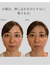 リ バース 立川(RE:birth)/小顔変化　BeforeAfter