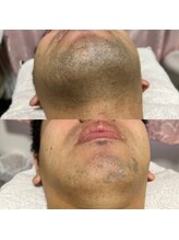 ボータン 恵(Beau Temps)/ヒゲ脱毛6日目