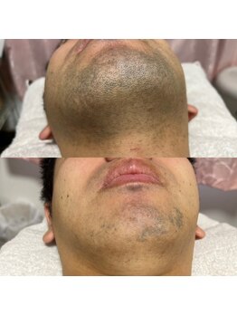 ボータン 恵(Beau Temps)/ヒゲ脱毛6日目