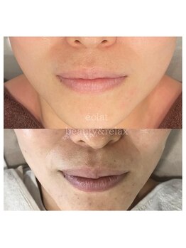 エクラ(eclat)/タラソトリートメント／継続