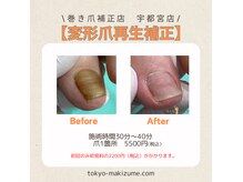 変形爪・分厚い爪再生補正