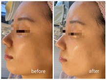 ミヌ 心斎橋(Minou)/ハーブピーリングbefore/after