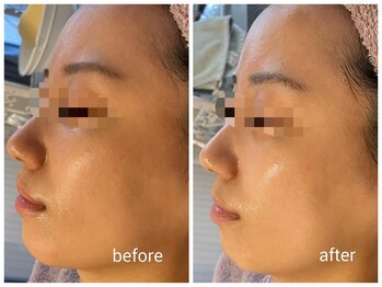 ミヌ 心斎橋(Minou)/ハーブピーリングbefore/after