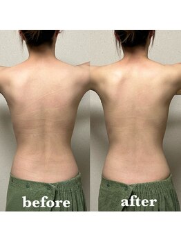 リーフィア(Leafia)/背中の肌質改善×むくみ取り