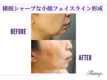 サンク(Thanq)/フェイスライン・二重あごケア