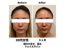 ラナン パラフューズ(Ranun's PARAFUSE.)の雰囲気（たるみ改善で小顔へ♪帽子もサイズダウンしてます♪）