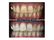 ホワイトニングショップ 和歌山店/Before&After美白ホワイトニング