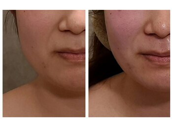 ウォーマル(warmaL)/小顔矯正/施術1回で浮腫み撃退！