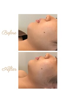 ウルエッテ(UluEtte)/顎下のもたつきも/循環小顔福岡