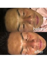 ナナラ(nanala)/メンズフェイシャル