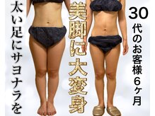 サロン ド ボーテ ラーンジュ 岐阜店(salon de beaut'e L'ange)/ハイパ-ナイフEX2ダイエット痩身