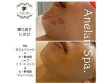 アネランスパ(Anelan Spa.)