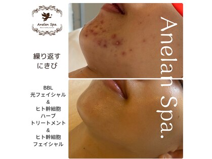 アネランスパ(Anelan Spa.)の写真