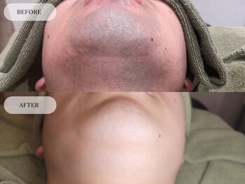 メンズプラス(MEN’S PLUS)/ヒゲ脱毛/ビフォーアフター写真