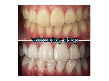 ホワイトニングショップ 和歌山店/Before&After美白ホワイトニング