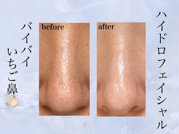 ミュー(professional beauty salon MYU)/黒毛穴ケアはお任せください!