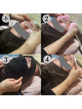 アピール(Appeal)/メンズヒゲ脱毛流れ-1