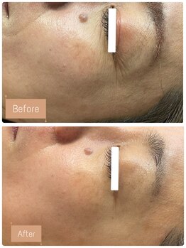 FJ/目尻シワほうれい線へ働きかける