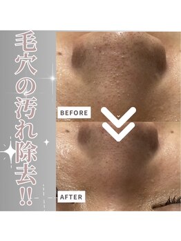 ランプシー(Lampsi)/毛穴の汚れ除去