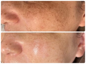 ブリリアント(Brilliant)/シミケア、シワケア美肌