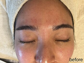 サロン ド エメ(salon de aimer)/【Before】赤み、火照るお肌に!