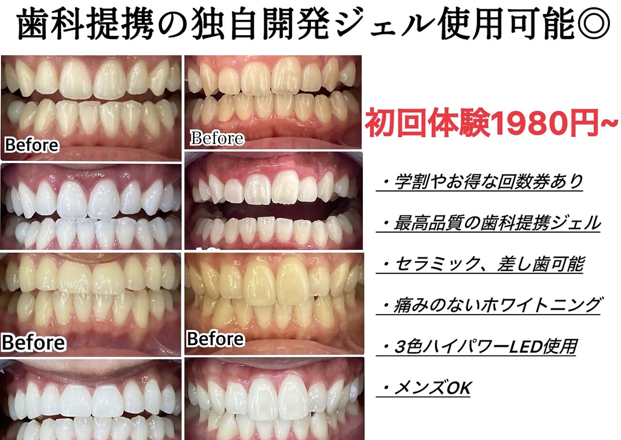 プラチナムホワイトニング