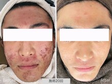 ニキビ研究所 千葉店/メンズのニキビ悩みにも