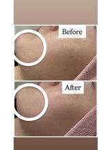 ペルボヌール 深井店/肌質改善ハーブピーリング1回