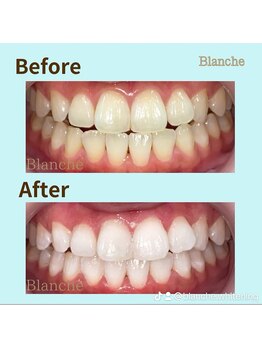 ホワイトニングサロン Blanche 心斎橋店/ビフォーアフター