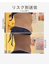 ビーシェイプ 君津(B-Shape)/【痩身】ビフォーアフター