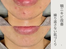 エン(en.)の雰囲気(繰り返す顎ニキビ改善)