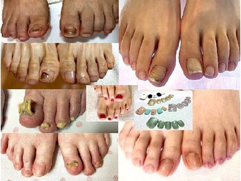 ビサンテ サロンの写真/足自爪ケア/自爪育成ケア/,自爪コーティング&角質ケア&角質育成ケア[足裏肌質改善],フットジェルネイル人気