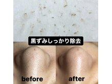 ビューティーネイル(Beauty Nail)/毛穴エクストラクション