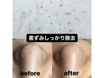 ビューティーネイル(Beauty Nail)/毛穴エクストラクション