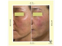 スプレール 水戸店/Wショット1回