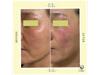 スプレール 水戸店/Wショット1回