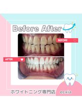 エクシアホワイトニング 札幌琴似店/ビフォーアフター