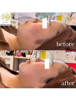 ベレミアム(Bellemium)/リフトアップ・キメの改善