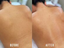 ビーグラム(B.GLAM)/シュガーリング／うなじ＋背中